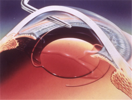 白內(nèi)障,希瑪瑞視眼科,上海眼科醫(yī)院