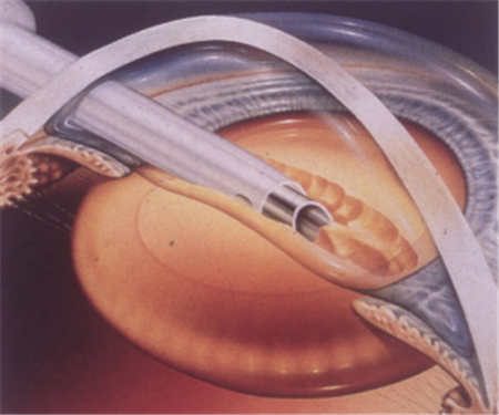 白內(nèi)障,?，斎鹨曆劭?上海眼科醫(yī)院