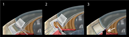 青光眼,?，斎鹨曆劭?上海眼科醫(yī)院