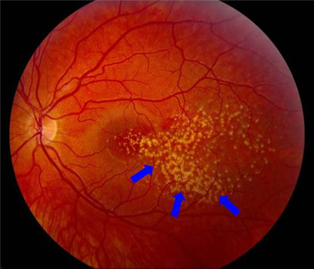 玻璃體視網(wǎng)膜,希瑪瑞視眼科,上海眼科醫(yī)院