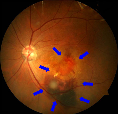 玻璃體視網(wǎng)膜,?，斎鹨曆劭?上海眼科醫(yī)院