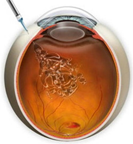 玻璃體視網(wǎng)膜,?，斎鹨曆劭?上海眼科醫(yī)院