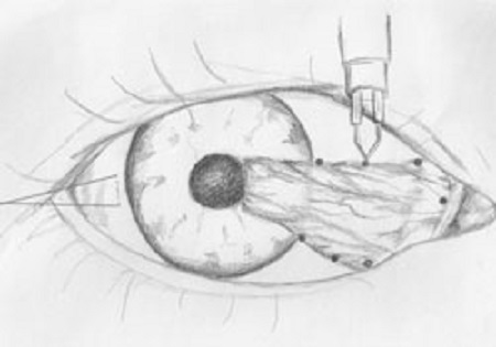 眼表眼角膜,?，斎鹨曆劭?上海眼科醫(yī)院