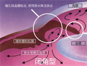 青光眼,?，斎鹨曆劭?上海眼科醫(yī)院