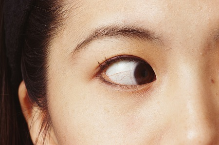 小兒眼病,?，斎鹨曆劭?上海眼科醫(yī)院