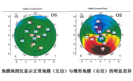 眼表眼角膜,?，斎鹨曆劭?上海眼科醫(yī)院