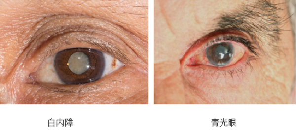 白內(nèi)障,?，斎鹨曆劭?上海眼科醫(yī)院