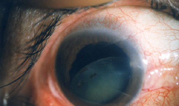 白內(nèi)障,希瑪瑞視眼科,上海眼科醫(yī)院