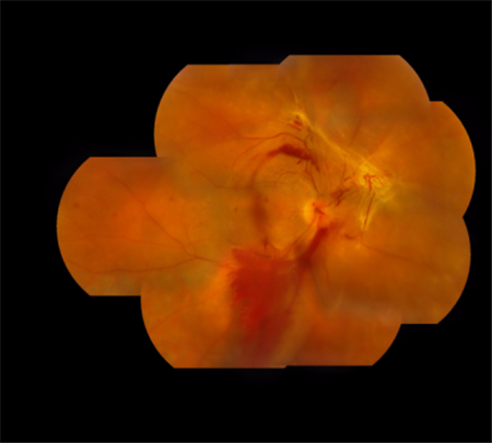 玻璃體視網(wǎng)膜,?，斎鹨曆劭?上海眼科醫(yī)院