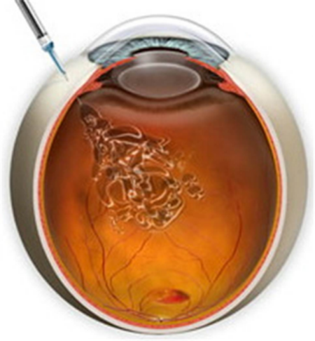 玻璃體視網(wǎng)膜,?，斎鹨曆劭?上海眼科醫(yī)院