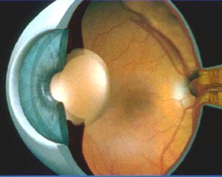 白內(nèi)障,希瑪瑞視眼科,上海眼科醫(yī)院