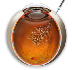 玻璃體視網(wǎng)膜,?，斎鹨曆劭?上海眼科醫(yī)院