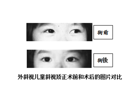 小兒眼病,?，斎鹨曆劭?上海眼科醫(yī)院