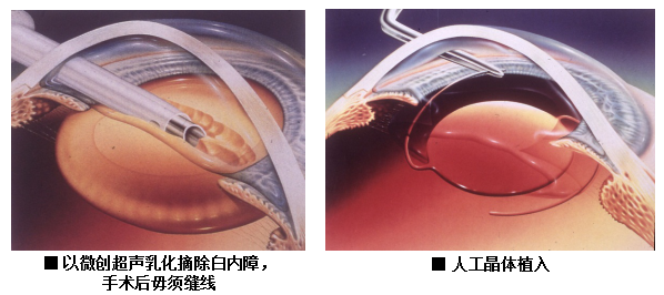 白內(nèi)障,?，斎鹨曆劭?上海眼科醫(yī)院