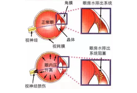 青光眼,?，斎鹨曆劭?上海眼科醫(yī)院