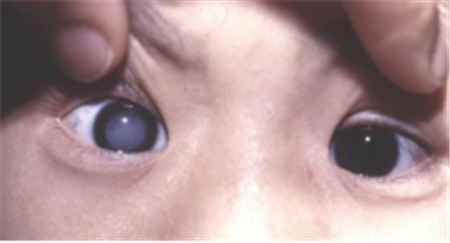 白內(nèi)障,?，斎鹨曆劭?上海眼科醫(yī)院