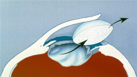 白內(nèi)障,希瑪瑞視眼科,上海眼科醫(yī)院