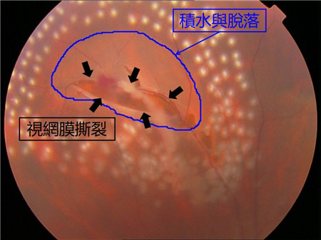 玻璃體視網(wǎng)膜,?，斎鹨曆劭?上海眼科醫(yī)院
