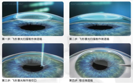 屈光矯視,?，斎鹨曆劭?上海眼科醫(yī)院