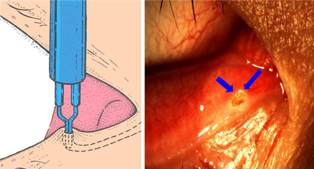 眼表眼角膜,希瑪瑞視眼科,上海眼科醫(yī)院