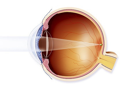 白內障,?，斎鹨曆劭?上海眼科醫(yī)院