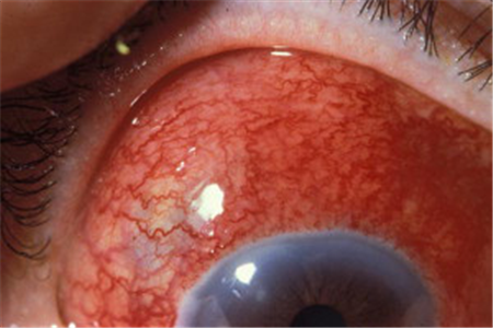 眼表眼角膜,?，斎鹨曆劭?上海眼科醫(yī)院