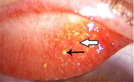 眼表眼角膜,?，斎鹨曆劭?上海眼科醫(yī)院