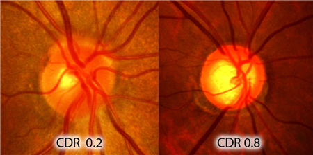 眼表眼角膜,?，斎鹨曆劭?上海眼科醫(yī)院