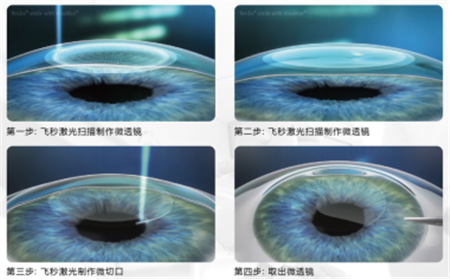 屈光矯視,?，斎鹨曆劭?上海眼科醫(yī)院