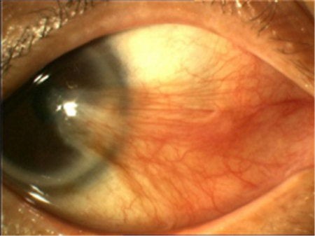 眼表眼角膜,?，斎鹨曆劭?上海眼科醫(yī)院