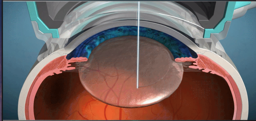 白內(nèi)障,希瑪瑞視眼科,上海眼科醫(yī)院