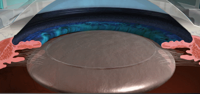 白內(nèi)障,?，斎鹨曆劭?上海眼科醫(yī)院