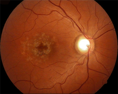 玻璃體視網(wǎng)膜,?，斎鹨曆劭?上海眼科醫(yī)院