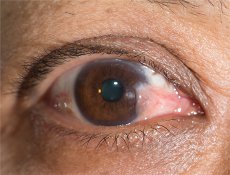 眼表眼角膜,希瑪瑞視眼科,上海眼科醫(yī)院