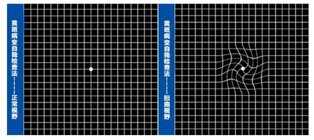 玻璃體視網(wǎng)膜,希瑪瑞視眼科,上海眼科醫(yī)院