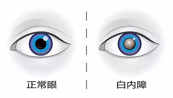 白內(nèi)障,希瑪瑞視眼科,上海眼科醫(yī)院