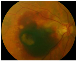 玻璃體視網(wǎng)膜,?，斎鹨曆劭?上海眼科醫(yī)院