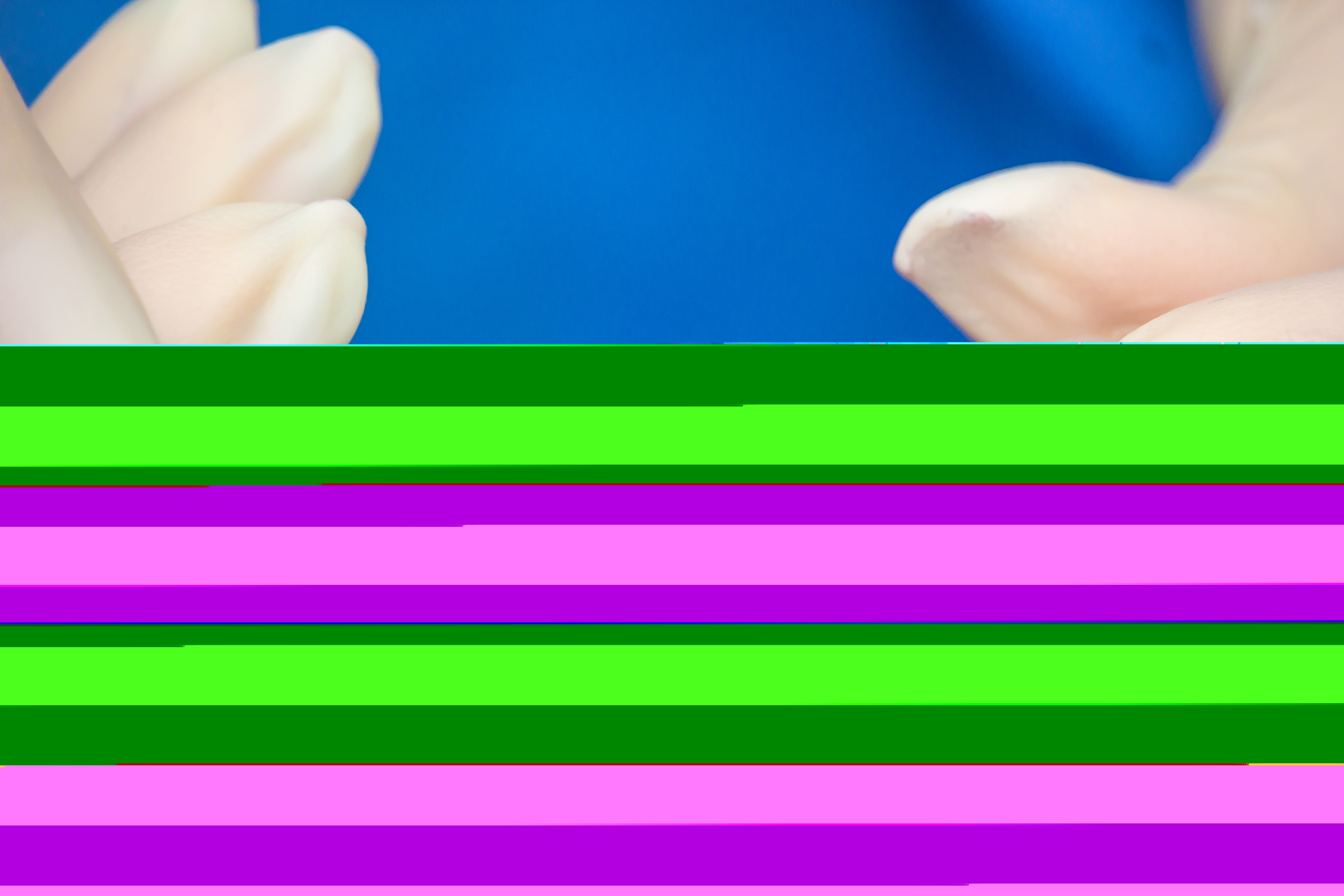 屈光矯視,?，斎鹨曆劭?上海眼科醫(yī)院