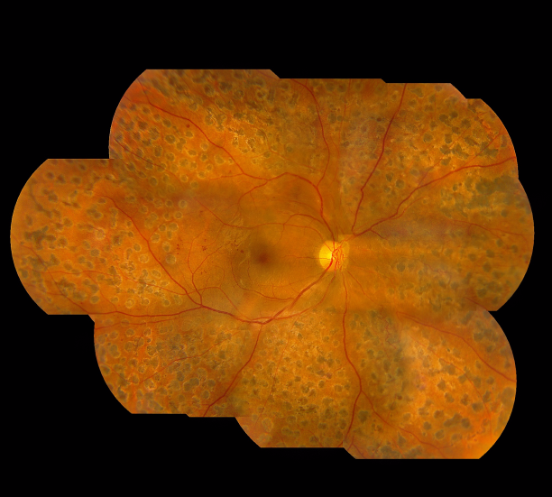 玻璃體視網(wǎng)膜,希瑪瑞視眼科,上海眼科醫(yī)院