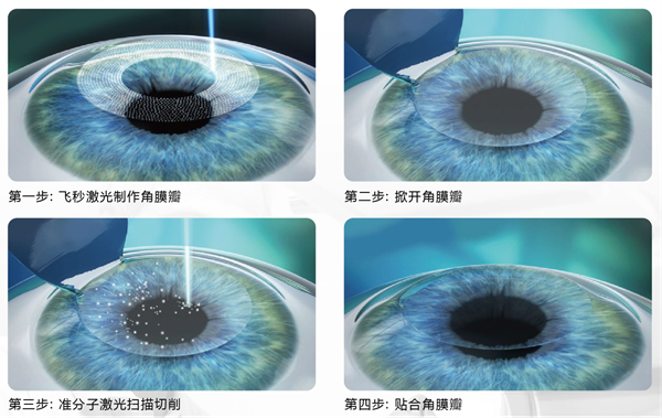 屈光矯視,?，斎鹨曆劭?上海眼科醫(yī)院