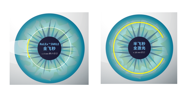 屈光矯視,希瑪瑞視眼科,上海眼科醫(yī)院