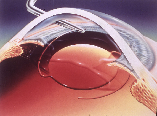 白內(nèi)障,?，斎鹨曆劭?上海眼科醫(yī)院