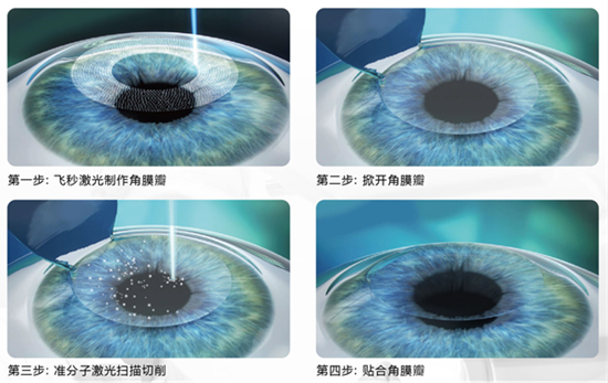 屈光矯視,?，斎鹨曆劭?上海眼科醫(yī)院