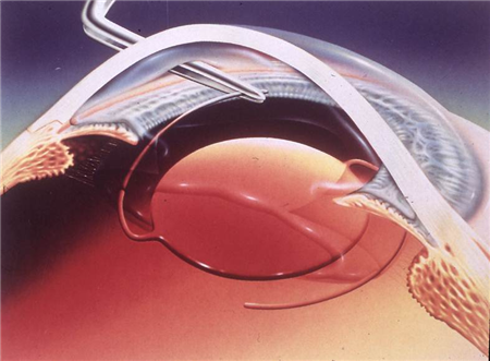 白內(nèi)障,希瑪瑞視眼科,上海眼科醫(yī)院