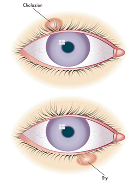 眼表眼角膜,?，斎鹨曆劭?上海眼科醫(yī)院