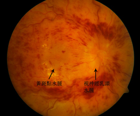 玻璃體視網(wǎng)膜,?，斎鹨曆劭?上海眼科醫(yī)院
