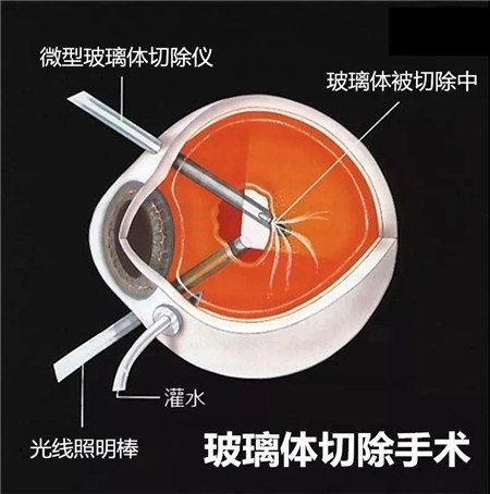 玻璃體視網(wǎng)膜,希瑪瑞視眼科,上海眼科醫(yī)院